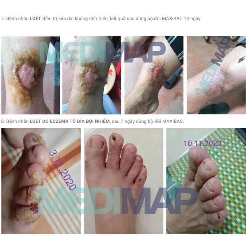 Gel kháng_khuẩn phục hồi da Maxibac