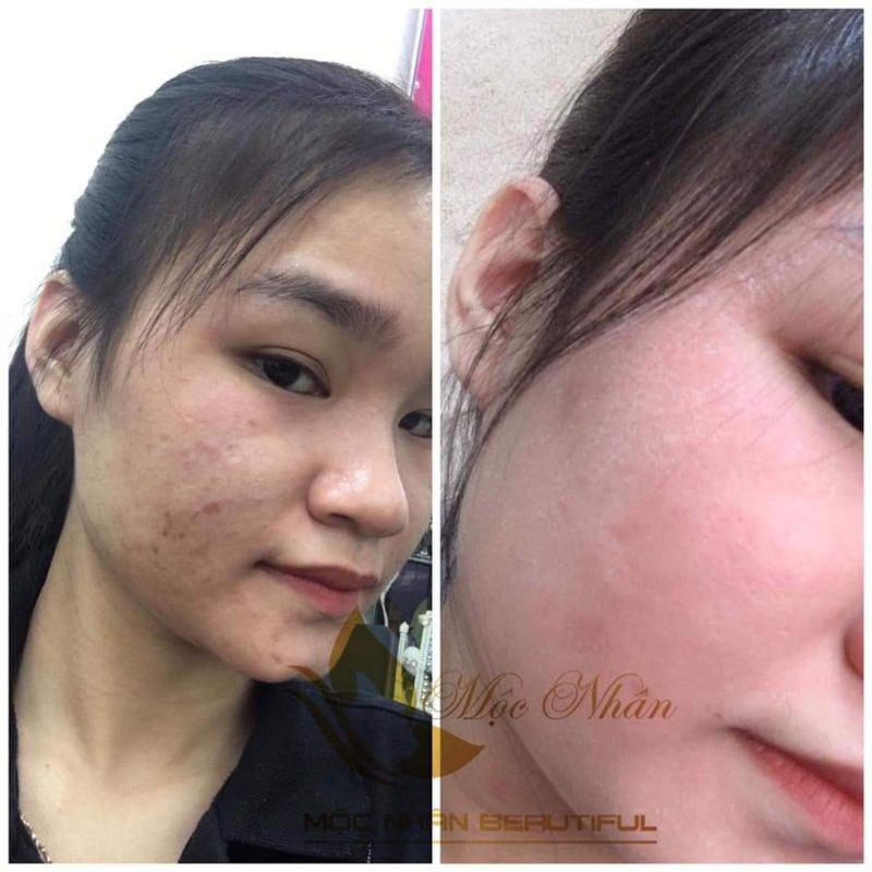 Combo ĐÔNG Y MỘC NHÂN TÁI TẠO DA CẤP
