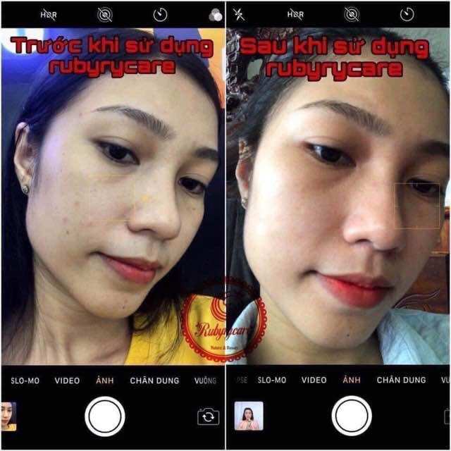 Thuốc trị mụn RubyCare