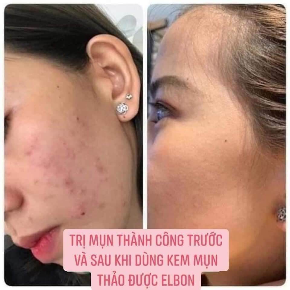 KEM MỤN,MỜ THÂM,TRẮNG DA