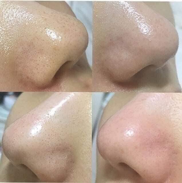 (30/50ml-CHIẾT CHAI NHỎ+QUÀ TẶNG) Dung Dịch Ủ Đẩy Mụn Đầu Đen MEDIPEEL EXTRA SUPER 9 COMPLEX