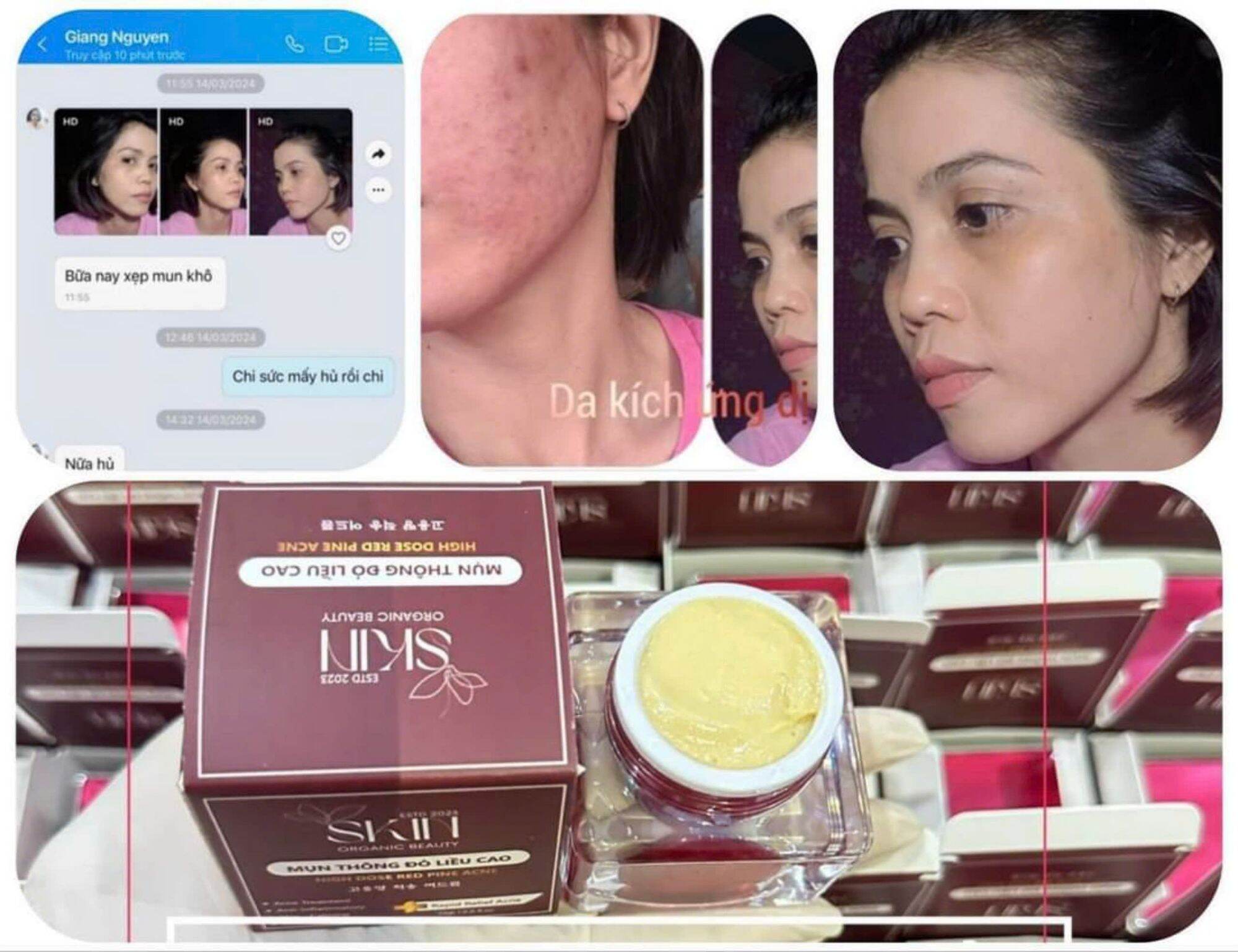 Kem face mụn thông đỏ liều cao 15gram