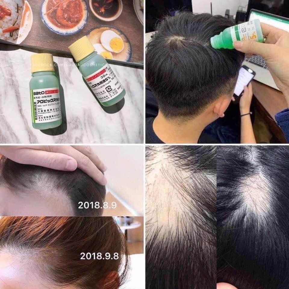 TINH CHẤT KÍCH THÍCH MỌC TÓC SATO NHẬT NỘI ĐỊA