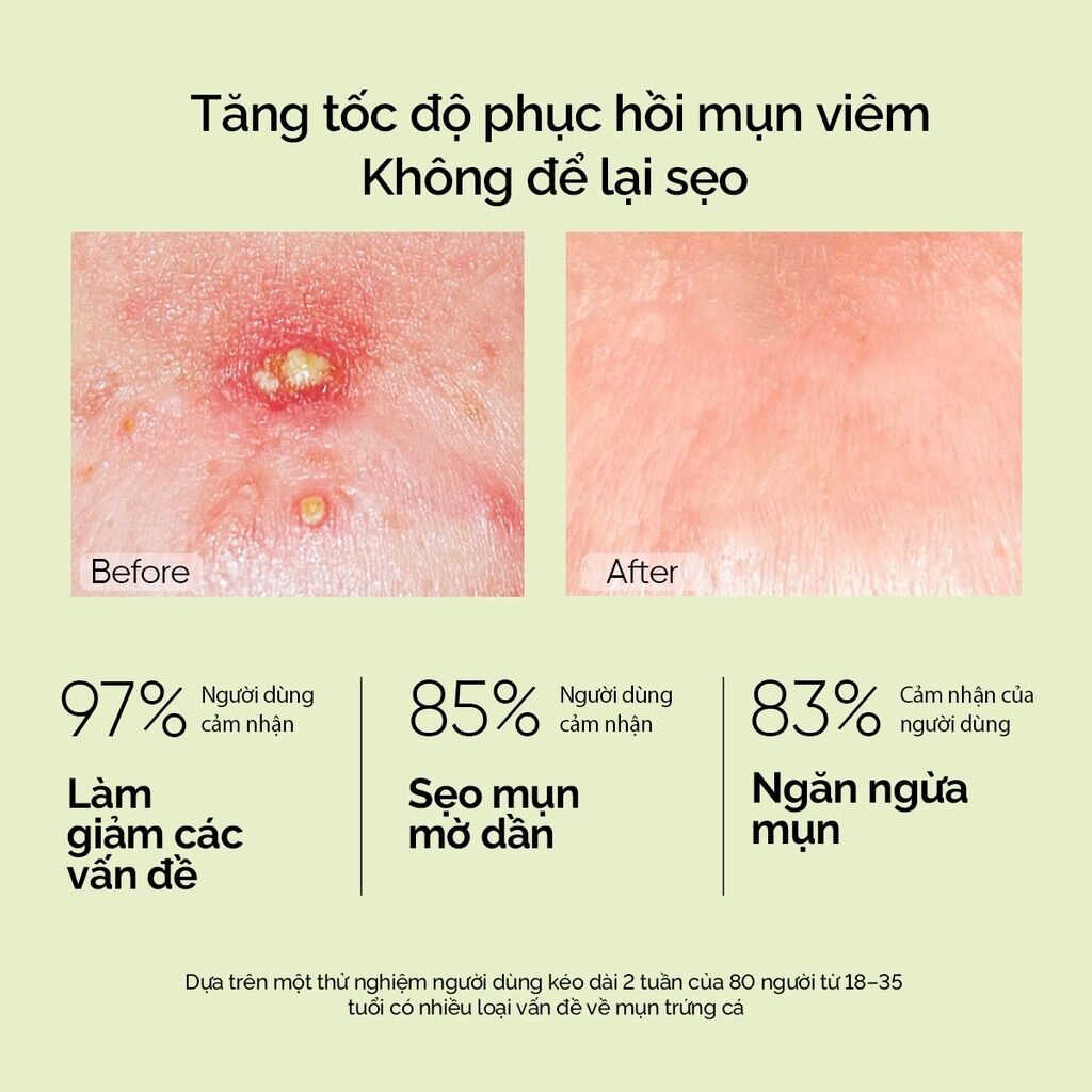 KEM CHẤM MỤN THẢO DƯỢC TRÀM TRÀ - DIẾP CÁ