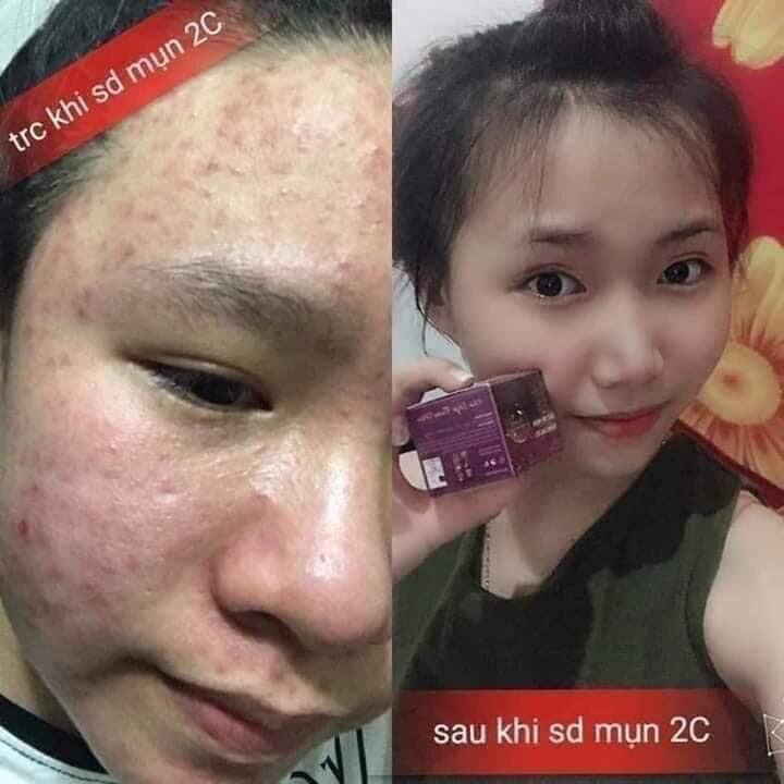 Combo 5 hộp kem mụn 2c giúp đánh bay mụn thâm