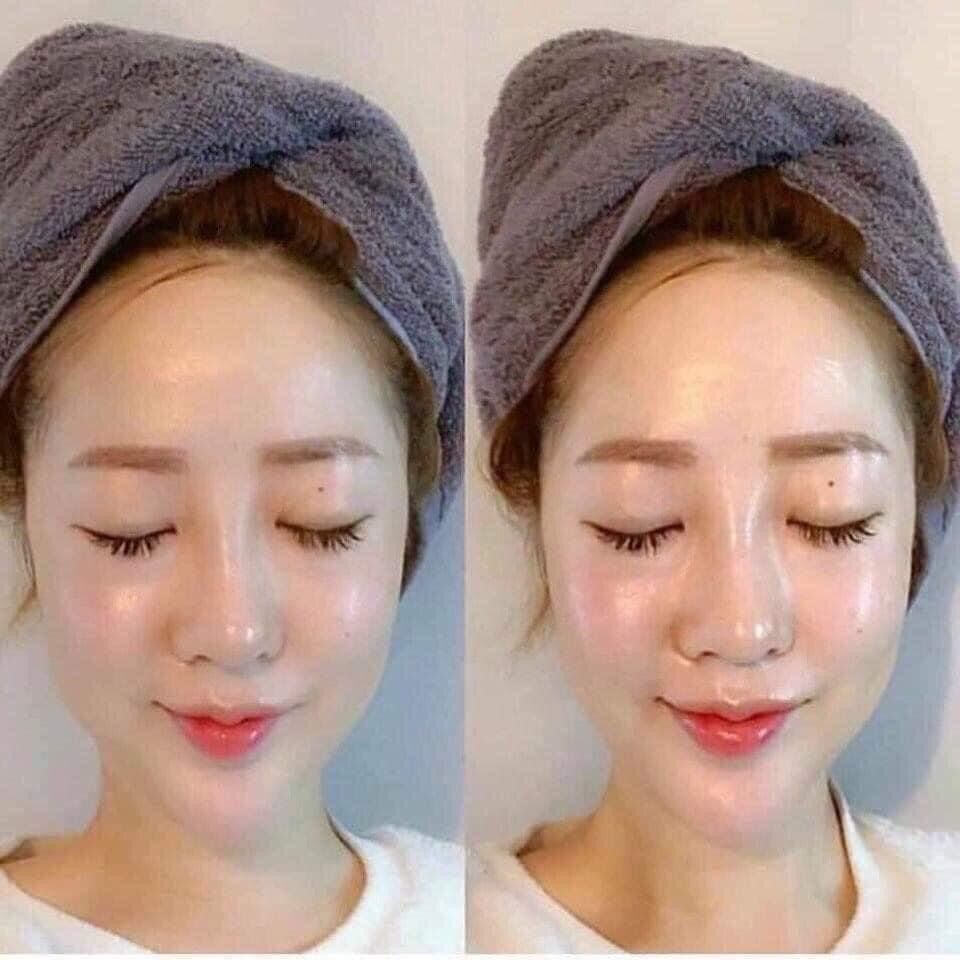 Tế Bào Gốc phục hồi da Ronas