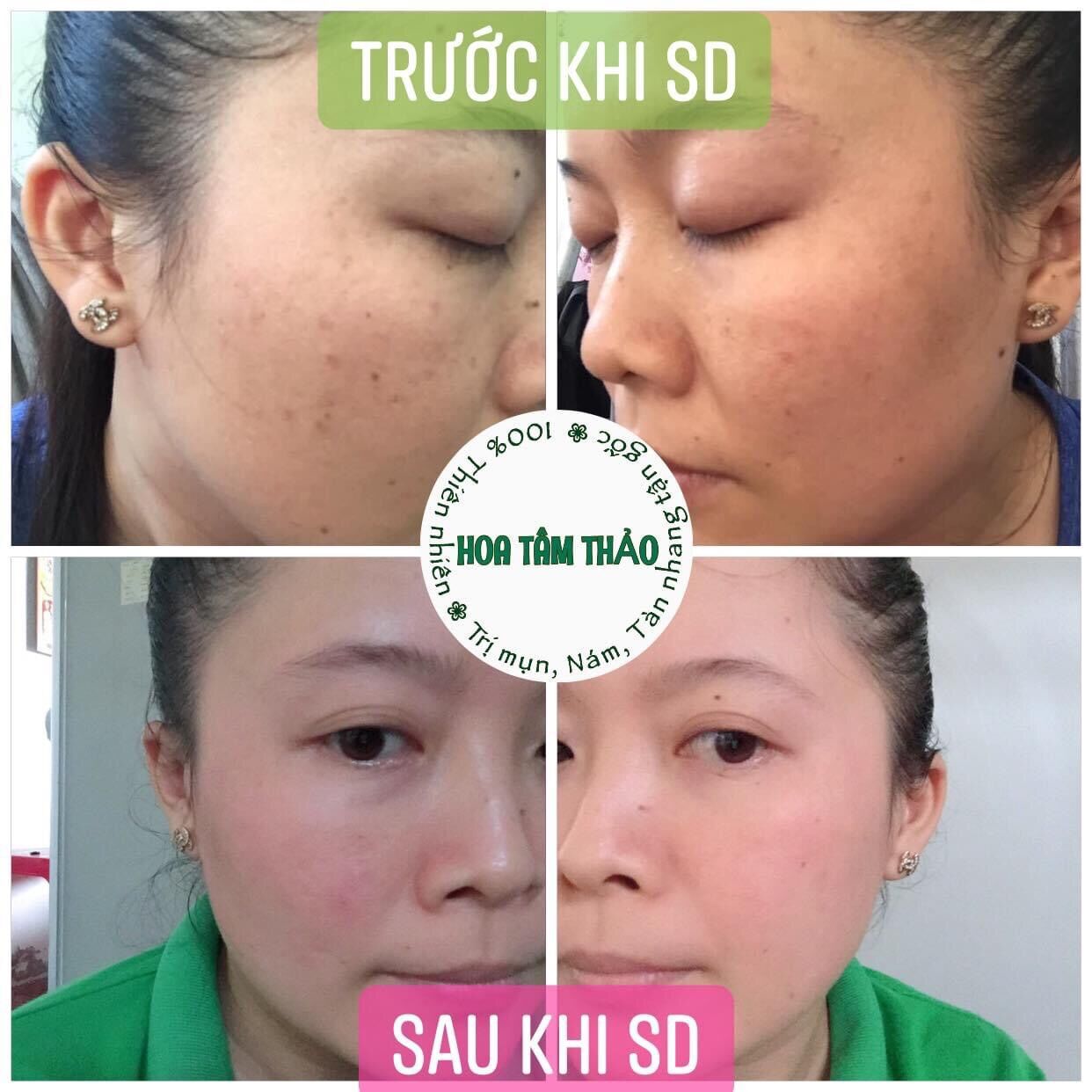 Combo thảo dược Hoa Tâm Thảo 100% thiên nhiên