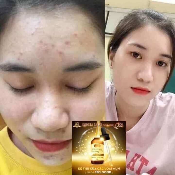 serum mụn