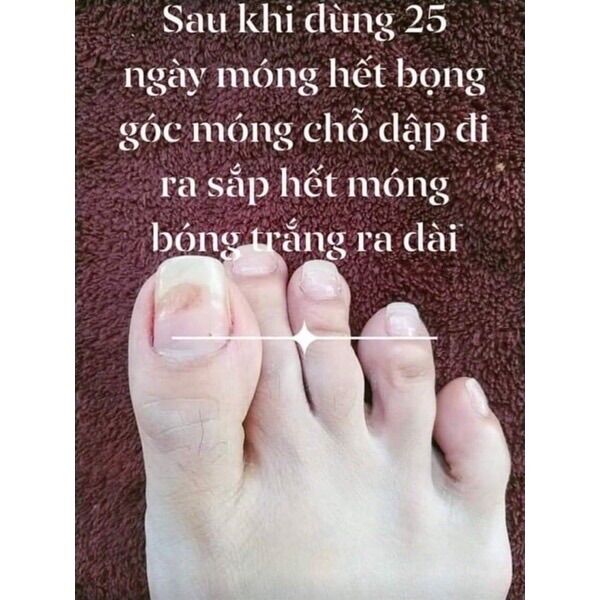 Dung Dịch Đánh Bay Nấm Móng _ Nấm Móng (1 chai )