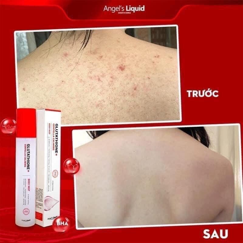 Xịt Giảm Mụn Và Xoá Thâm Lưng