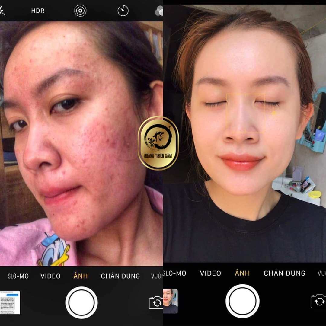 combo tinh chất Hoàng Thiên Sâm (loại mạnh)