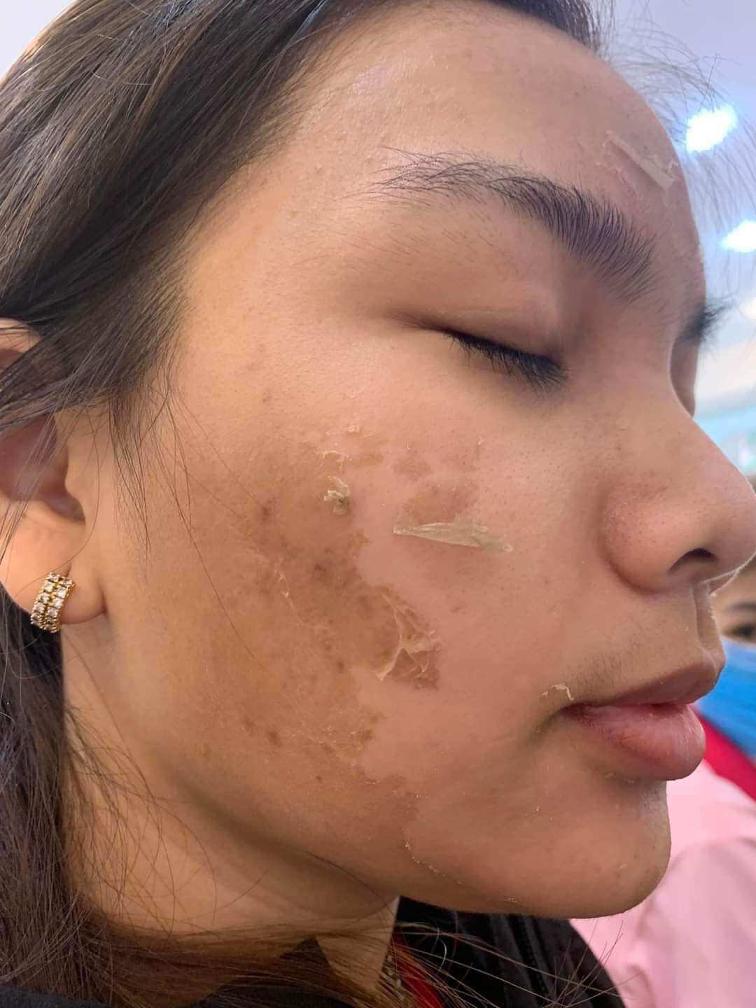 Peel Bong Mạnh Tái Tạo Da