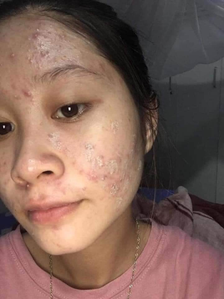 Cao sâm mụn chuyên mụn và thần thánh mụn