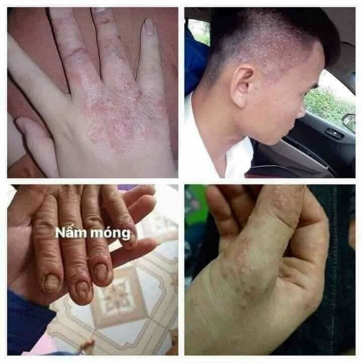 Nấm ngứa ngoài da: hắc lào, nấm ngứa, tổ đỉa,ghẻ lở.....
