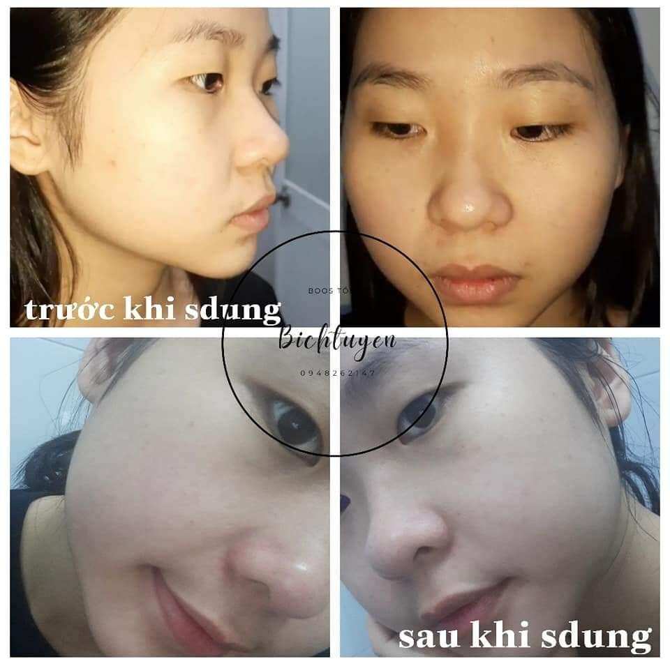 THẢO MỘC XANH SERUM MỤN THAY ĐỔI RÕ RỆT SAU 5 NGÀY SỬ DỤNG