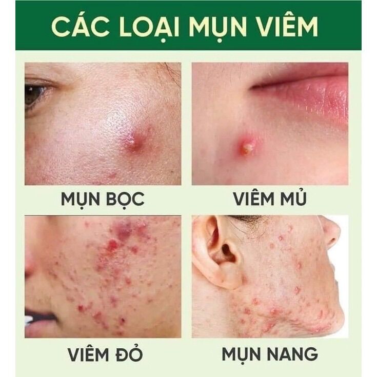 KEM MỤN BESU CAO CẤP