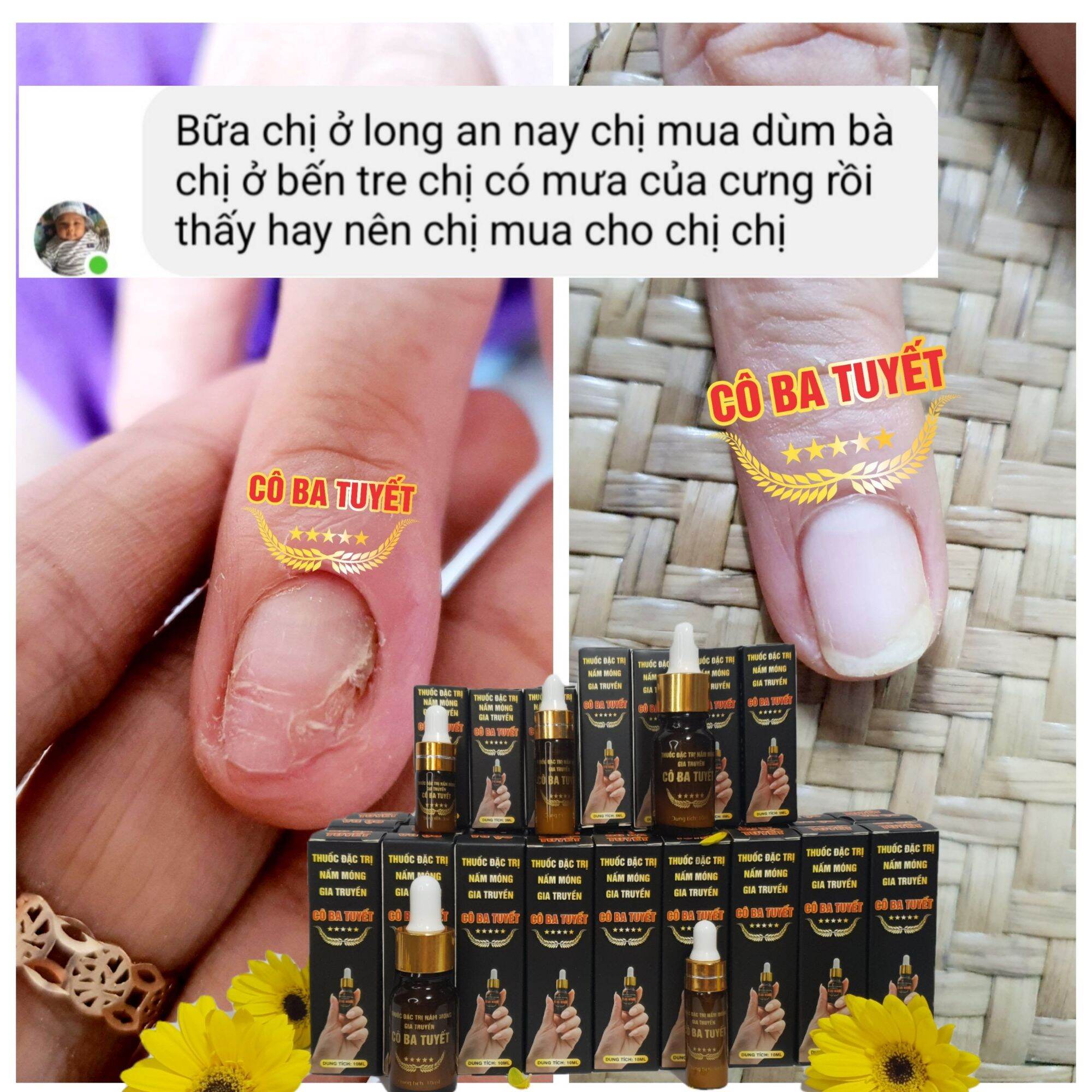 Nấm móng tay chân CO BA TUYẾT