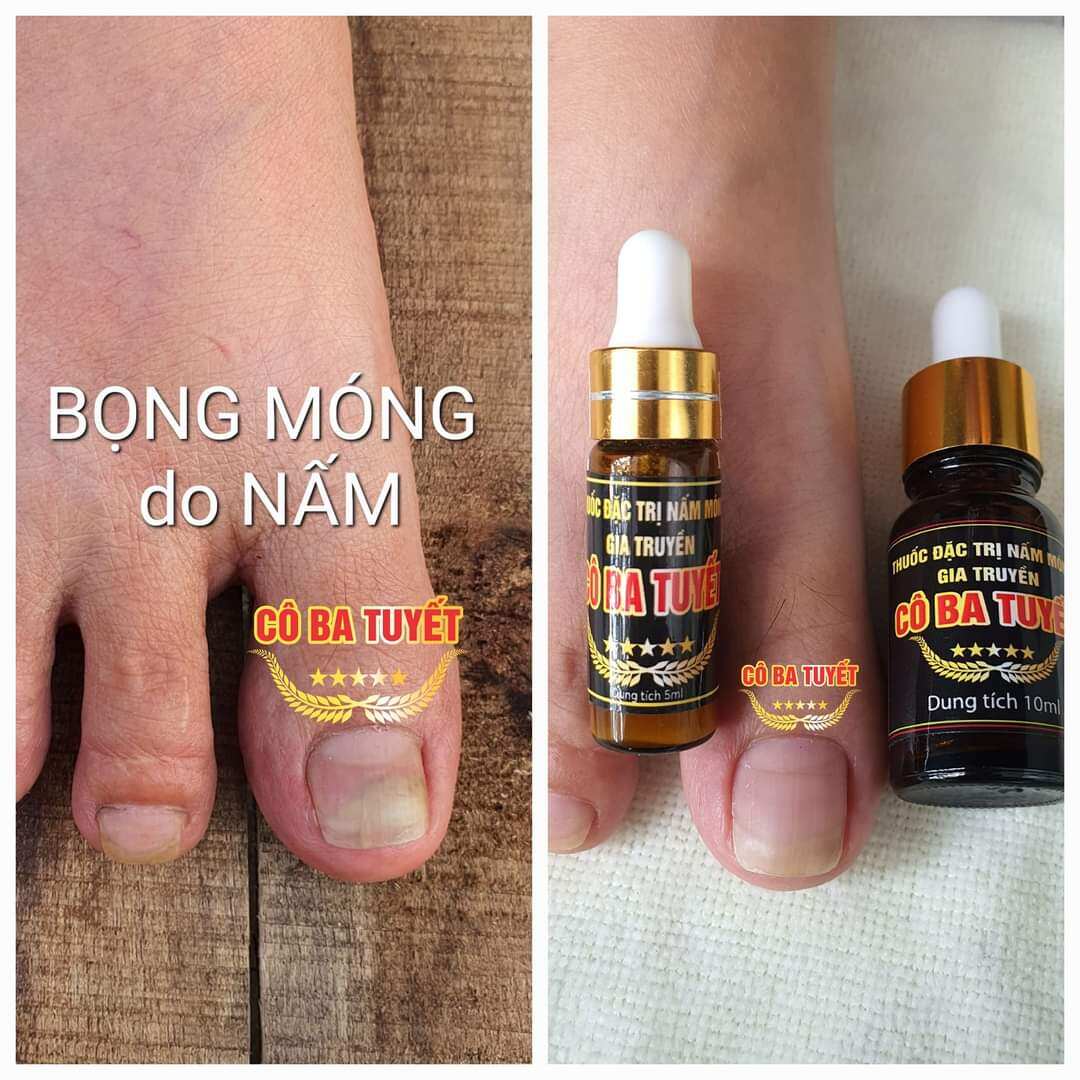Nấm Móng Cô Ba Tuyết chuyên tri nấm móng, hư khóe, nước ăn tay chân, dưỡng móng 2 chai 3 ml
