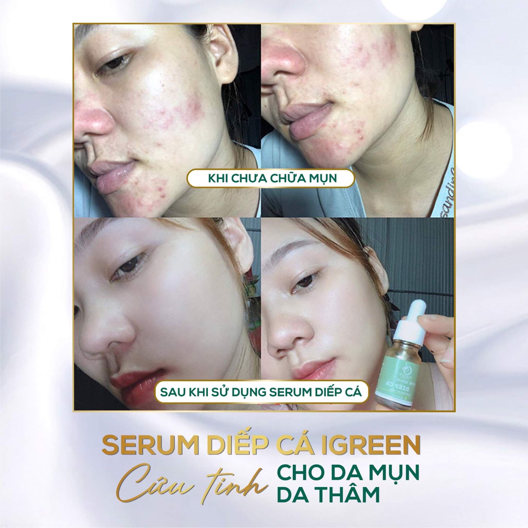 COMBO TOÀN DIỆN IGREEN-SẠCH MỤN,THÂM( serum diếp cá+sữa rửa mặt diếp cá)