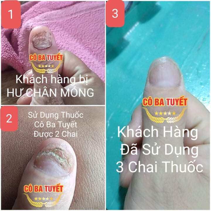 Cô Ba Tuyết . Nấm móng , Bọng Móng , Hư Khóe 2 chai 3ml