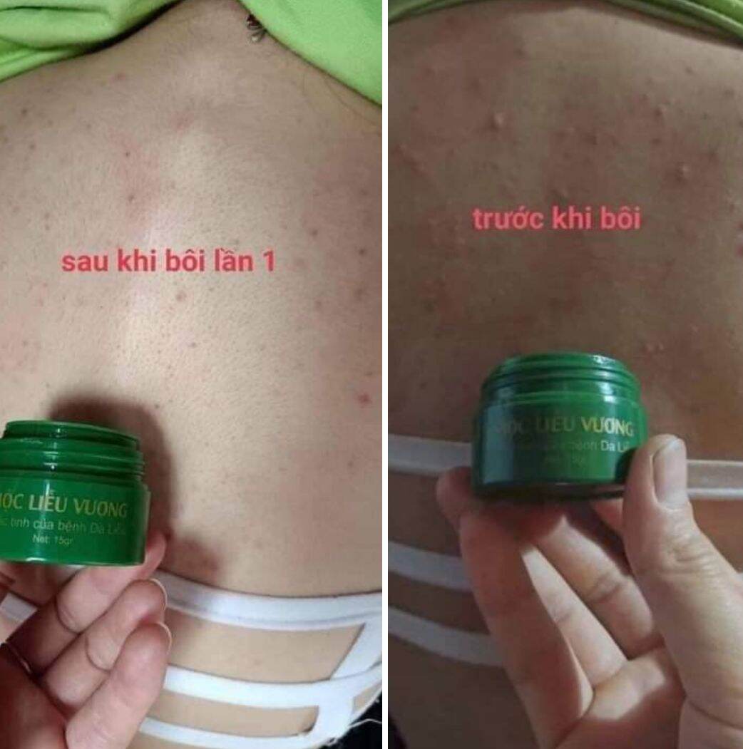 KEM BÔI DA MỘC LIỄU VƯƠNG (KHẮC TINH CÁC BỆNH VỀ DA )