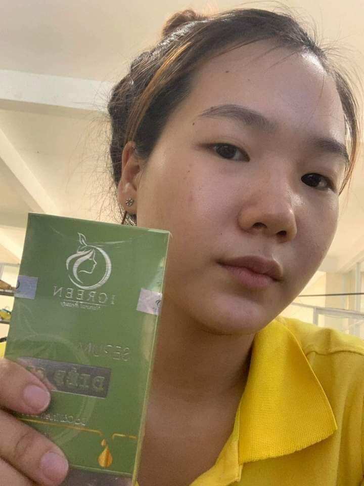 COMBO 3 MÓN SẠCH MỤN IGREEN ( mặt nạ serum và sữa rửa mặt)