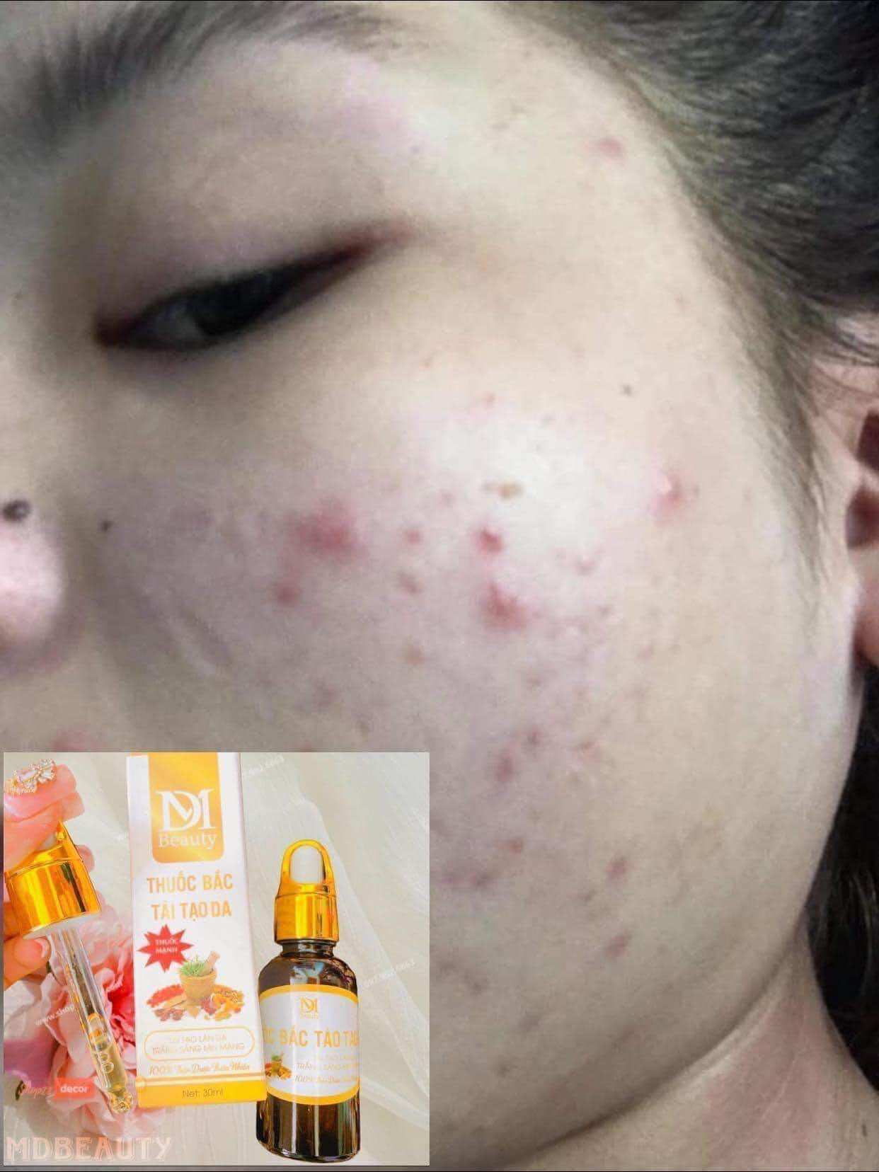 Thuốc bắc tái tạo da ( chính hãng)lẻ = sỉ