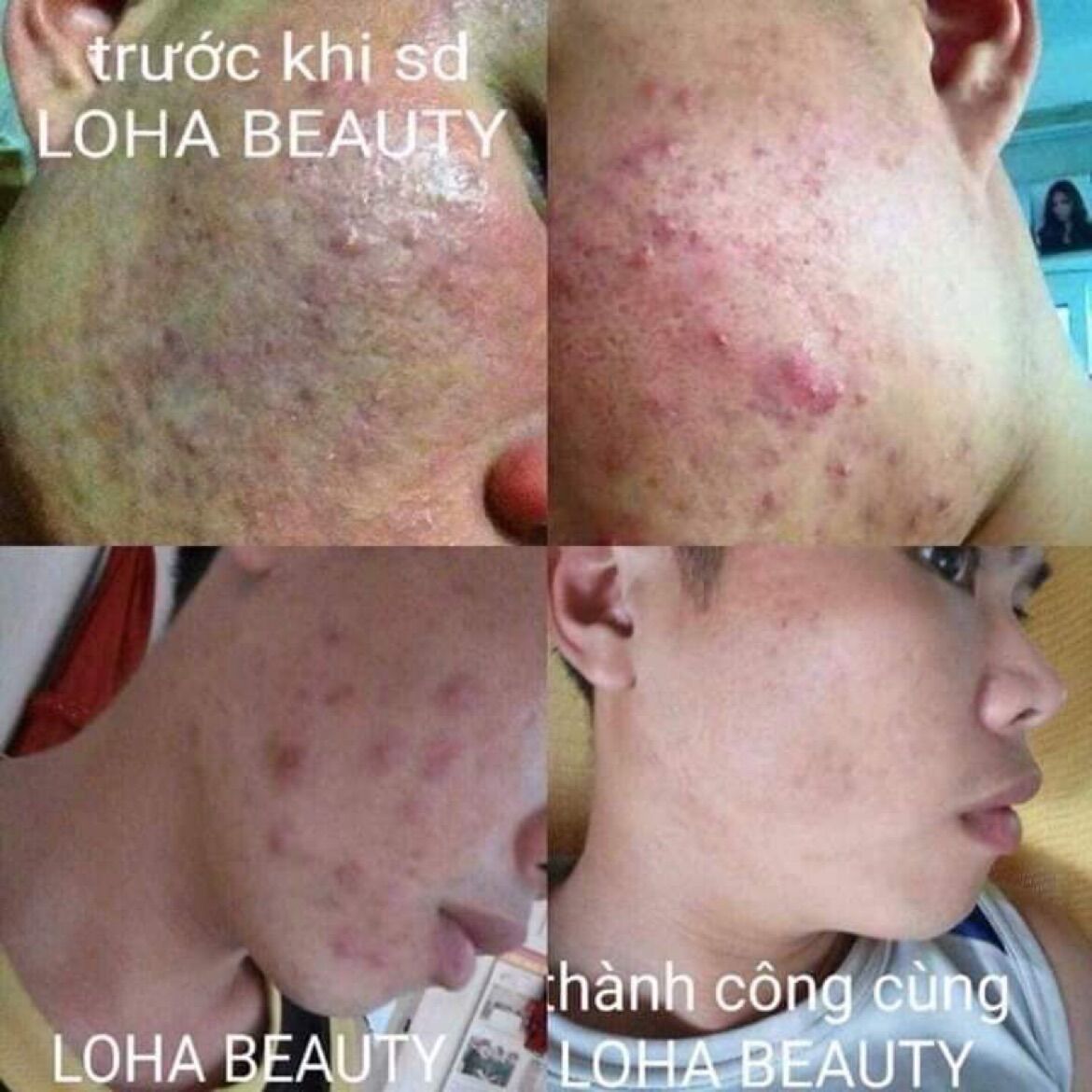 Tinh chất tái tạo da loha beauty (100ml tặng toner)