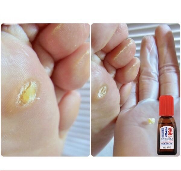 Dung dịch mụn cóc Nhật Bản 6ml-10ml