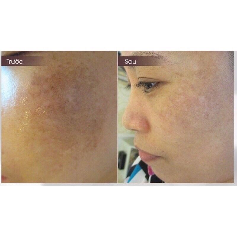 Serum giảm nám Nanoluxe Reluma TM