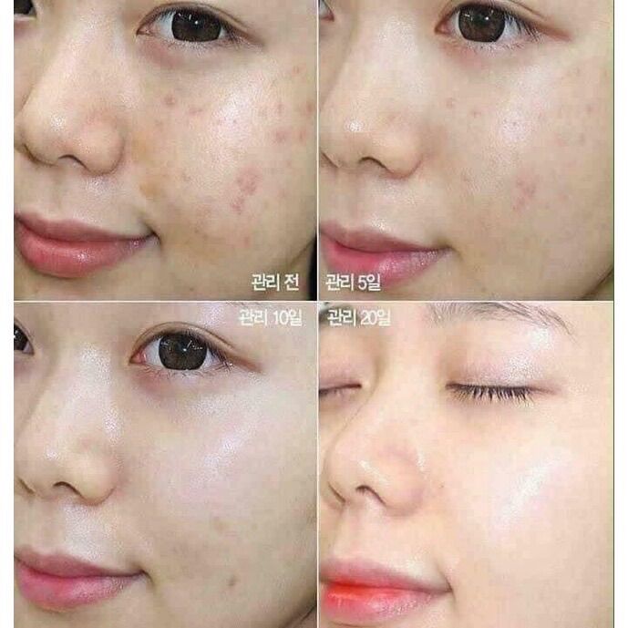Serum rau má Centella mờ thâm mụn trắng da dành cho da thâm, da mụn 100ml