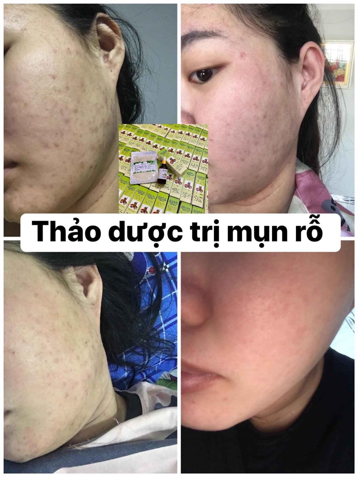 THẢO DƯỢC SẠCH MỤN MT (50ml)