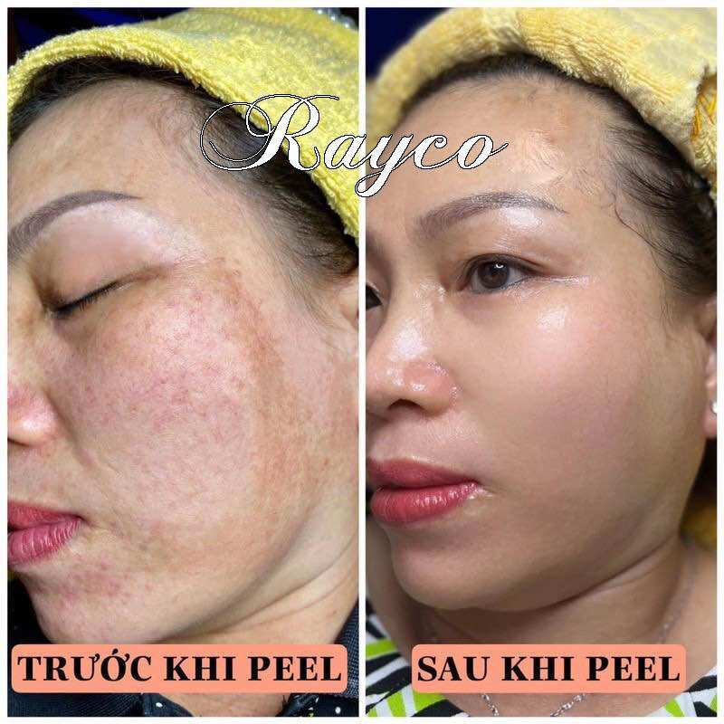 Peel Bong Mạnh Tái Tạo Da