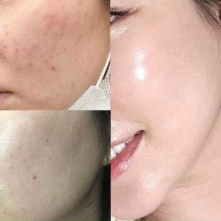 MẶT NẠ TẢO VOLAYON SPINEM CÓ CHIẾT