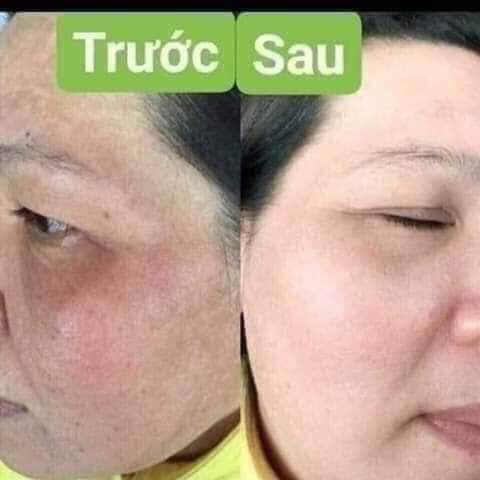 Kem chuyên nám huỳnh đỗ