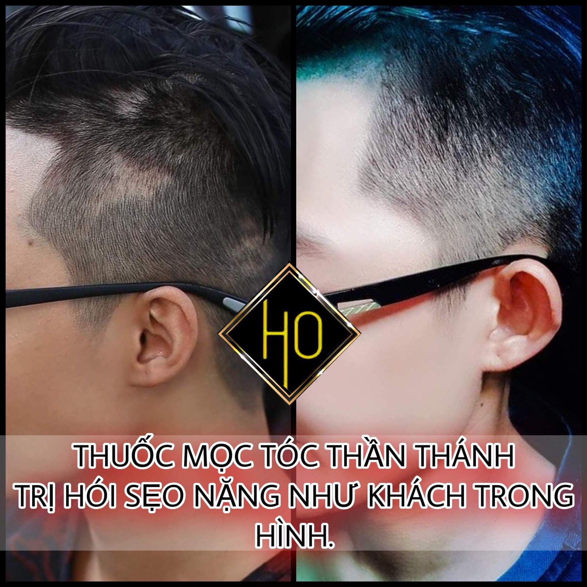 SẢN PHẨM MỌC TÓC NGUYỄN HỒ X3PLUS 18%