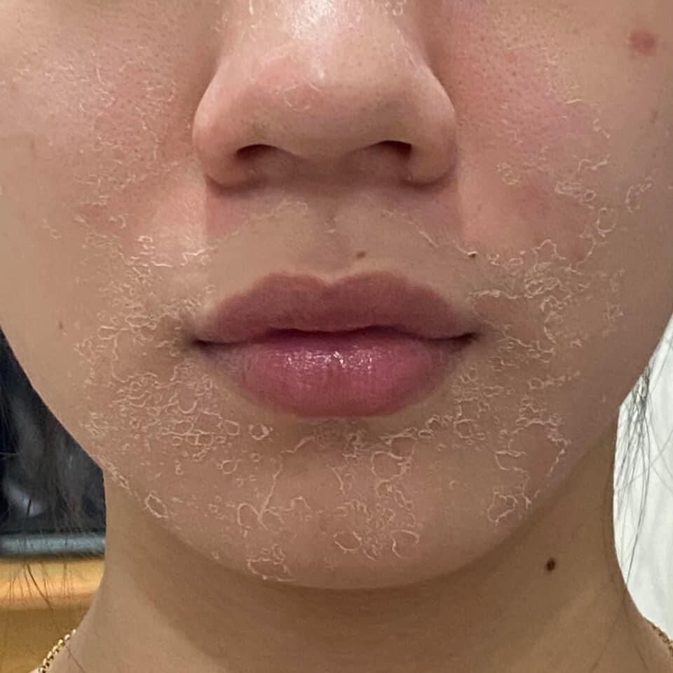 Tinh chất thay da sinh học NeoStrata ProSystem Retinol Peel