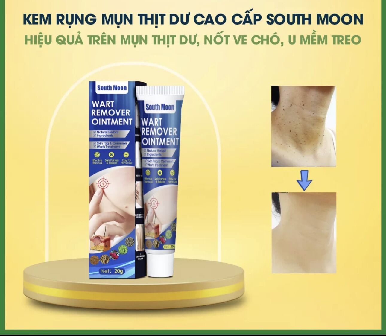 Kem mụn thịt dư cao cấp South Moon, Kem tẩy nốt ruồi, mụn thịt dư, nốt ve chó, u mềm treo, South Moon chính hãng
