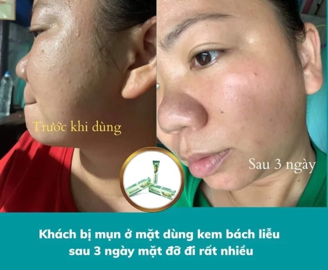Kem bôi da thảo dược Bách Liễu 15gr