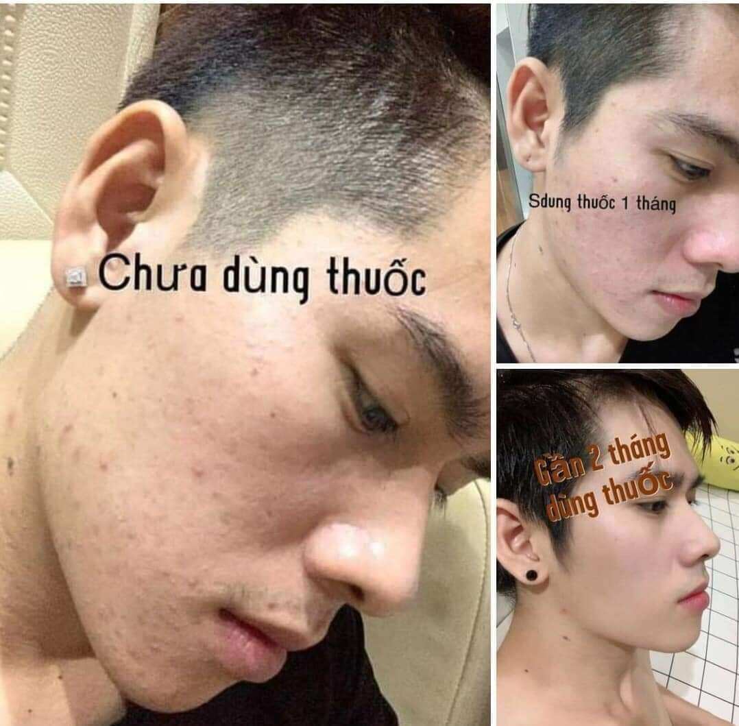 [MUA 1 TẶNG 1] COMBO TÁI TẠO HỎA TỐC RED PEEL MẪU MỚI 2% 2022