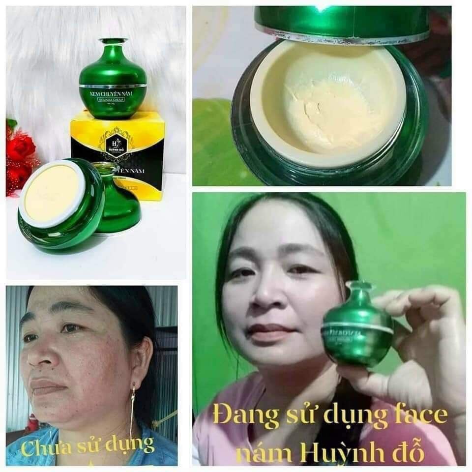kem chuyên nám huỳnh đỗ