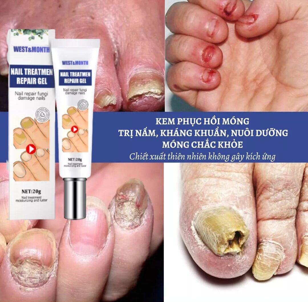 Kem trị sạch nấm móng tay,chân, tạo móng mới sáng đẹp dưỡng ẩm móng tay chân