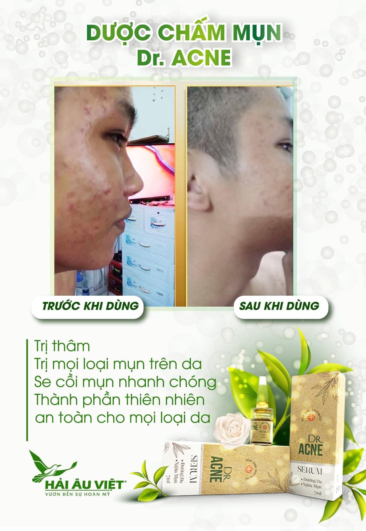 Dược chấm mụn dr acne sạch mụn nhanh