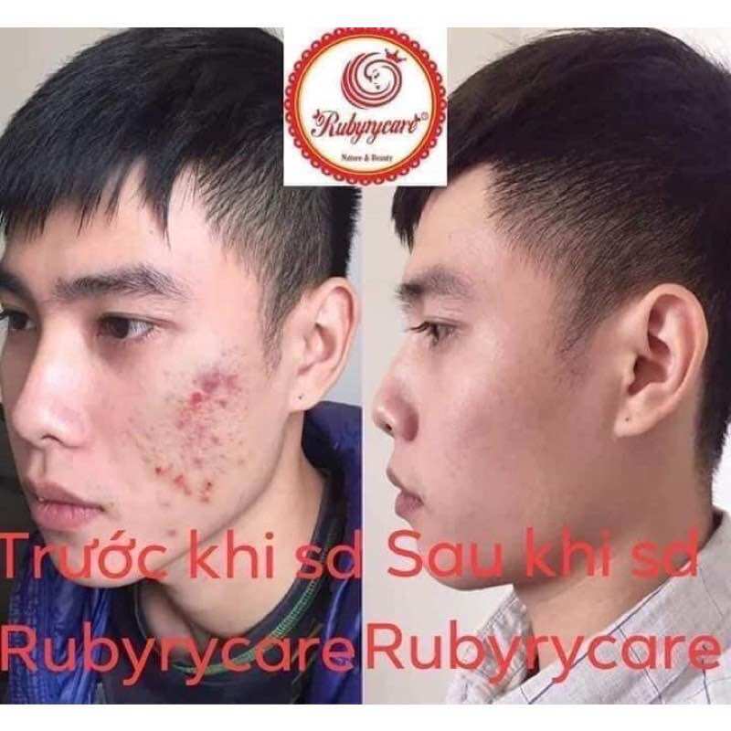 Thuốc trị mụn RubyCare