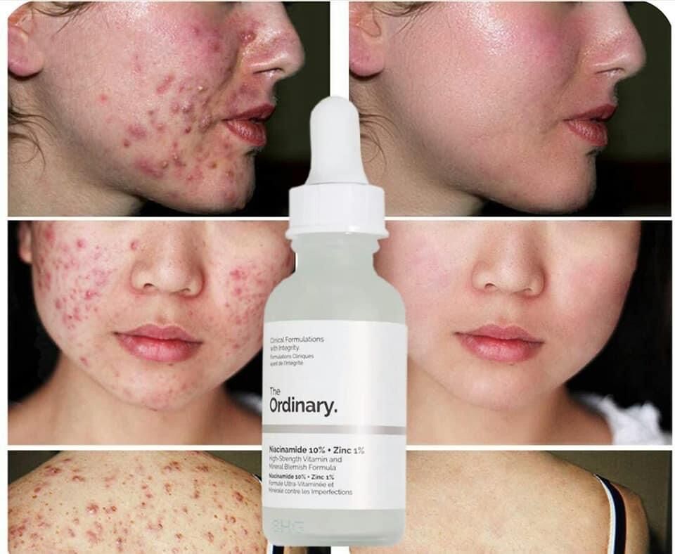 THE ORDINARY NIACINAMIDE 30ML ⚡️⚡️⚡️ BILL US MỚI NHẤT