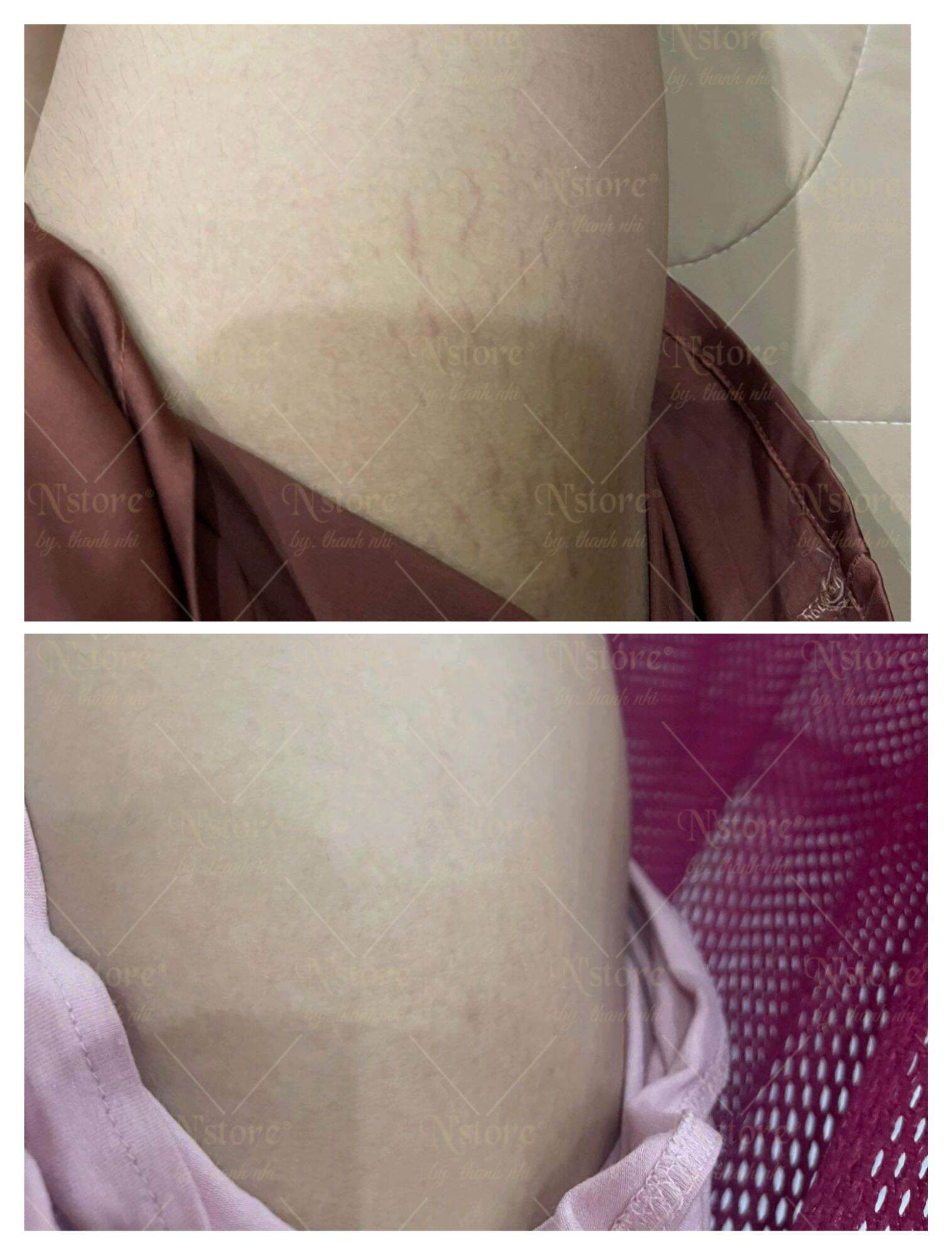 Mỡ Trăn & Ngọc Lan Tây - DÀNH CHO DA MỤN, TRIỆT LÔNG