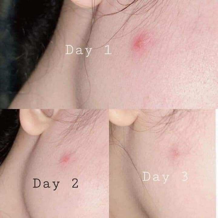 Serum mụn LUMOS ACNE 5ml chính hãng US