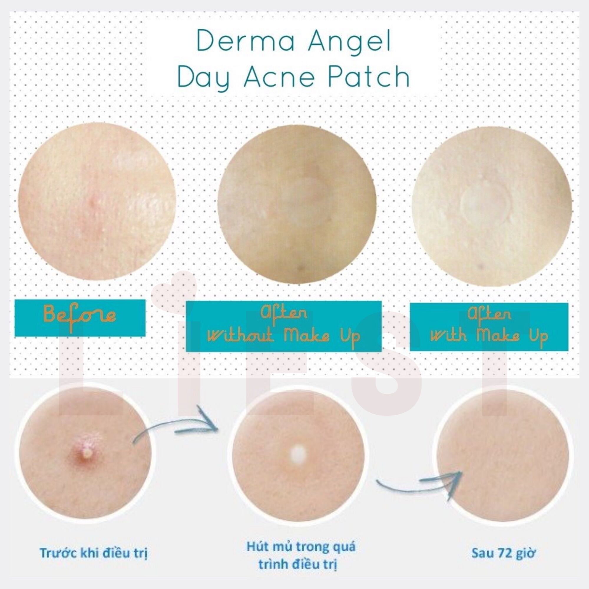 Miếng Dán Mụn Derma Angel ngày 12 miếng và đêm 6 miếng (miếng dán mụn derma angel mới) goodsgood