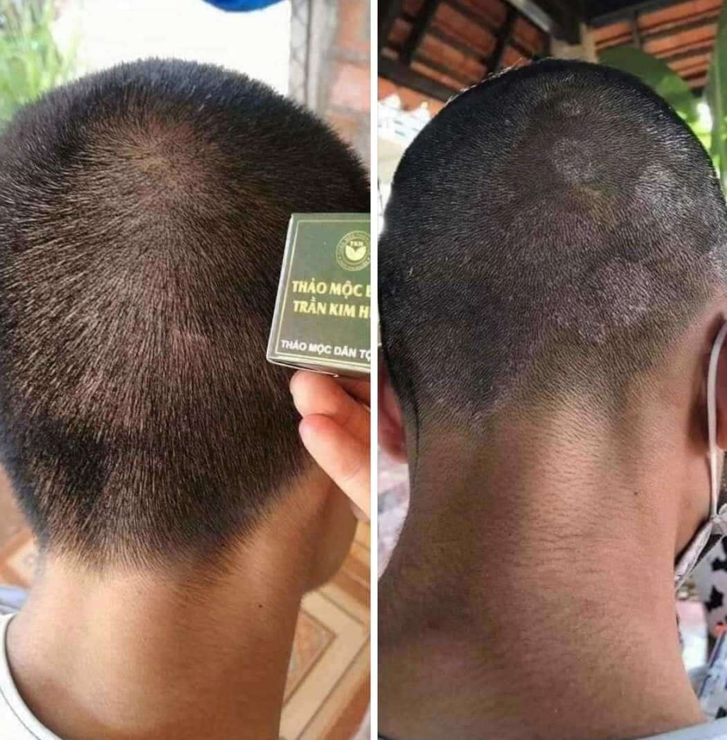 thảo mộc bôi da