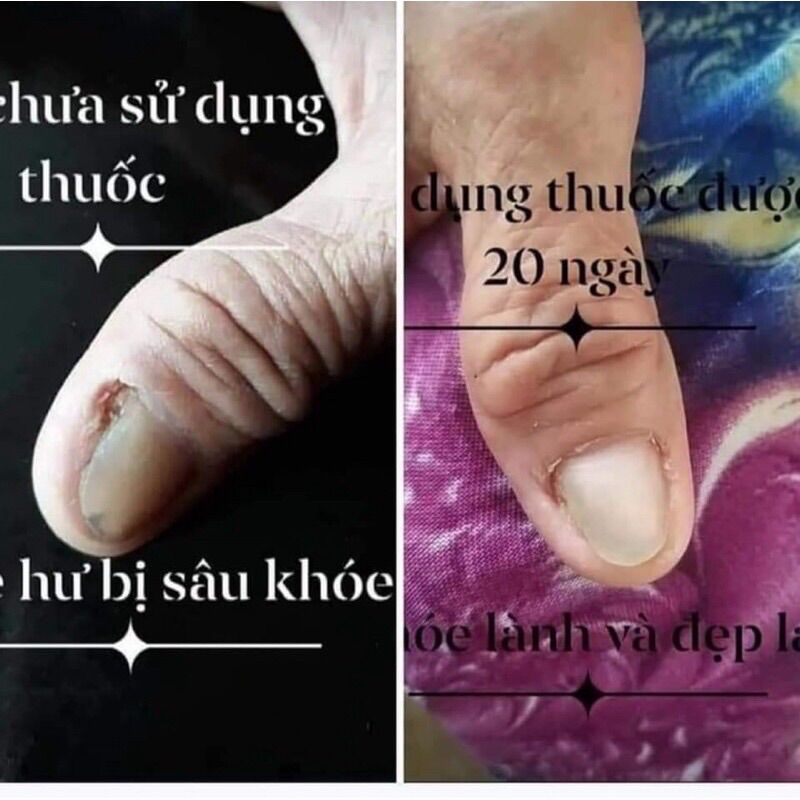 Dung Dịch Đánh Bay Nấm Móng _ Nấm Móng (1 chai )